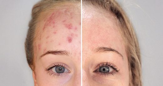 Endocare Biretix Micropeel 50ml