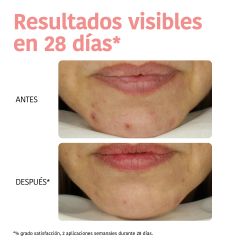 Iroha Nature Mascarilla Peeling Ácido Glicólico