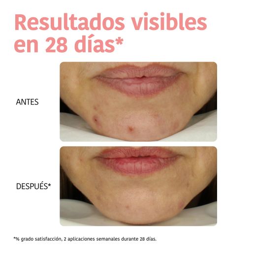 Iroha Nature Mascarilla Peeling Ácido Glicólico