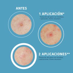 Iroha Nature Parches SOS Granos con Ácido Salicílico 18 unidades