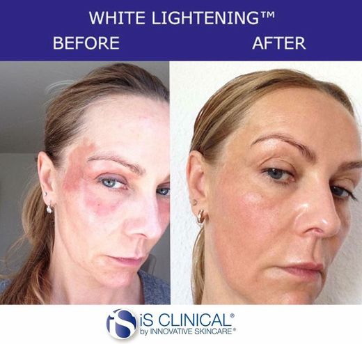 Ist Clinical White Lightening Serum 15ML