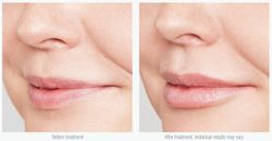 Is Clinical Lip Duo (Lip Polish + Youth Lip Elixir)